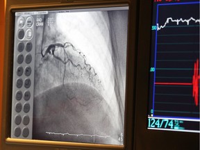 A monitor is shown during an angioplasty in this file photo.