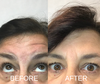 Botox treatments show before-and-after closeup of Lee-Ann Suzor’s forehead.
