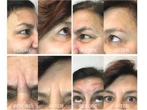 Before and after images show the effect of Botox treatments on Lea-Ann Suzor’s right and left eyes (top), frown lines (bottom left) and  forehead following treatment at Coral Media Health Spa.