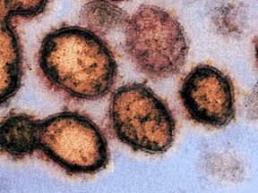An electron microscope image of SARS-CoV-2 particles, courtesy of the U.S. National Institutes of Health.