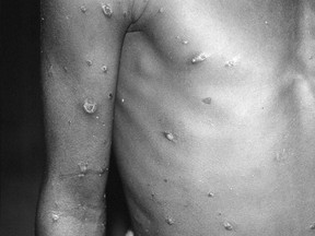 A photo showing swollen lymph nodes and rash on a monkeypox patient in the Democratic Republic of Congo, 1996 to 1997.