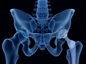 Hip replacement surgery wait times have worsened in Manitoba.