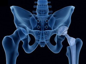 Hip replacement implant installed in the pelvis bone. X-ray view