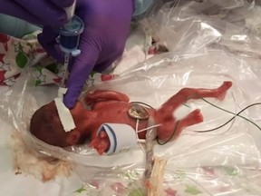 Worlds smallest baby was recently born at Sharp Mary Birch Hospital in San Diego. (Youtube)