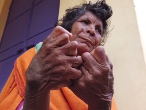 Kumari Nayak of India was born with 31 digits. (Video screen grab)