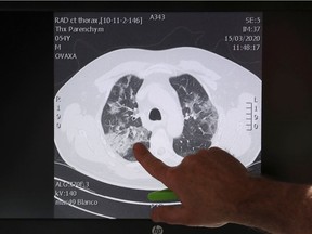 Belgian Doctor Ignace Demeyer, Chair Department of Emergency Medicine at Onze Lieve Vrouw Hospital, points to a scanner image of the lungs of a patient suffering from the coronavirus disease (COVID-19) (scan taken on March 15, 2020) in Aalst, Belgium March 17, 2020.